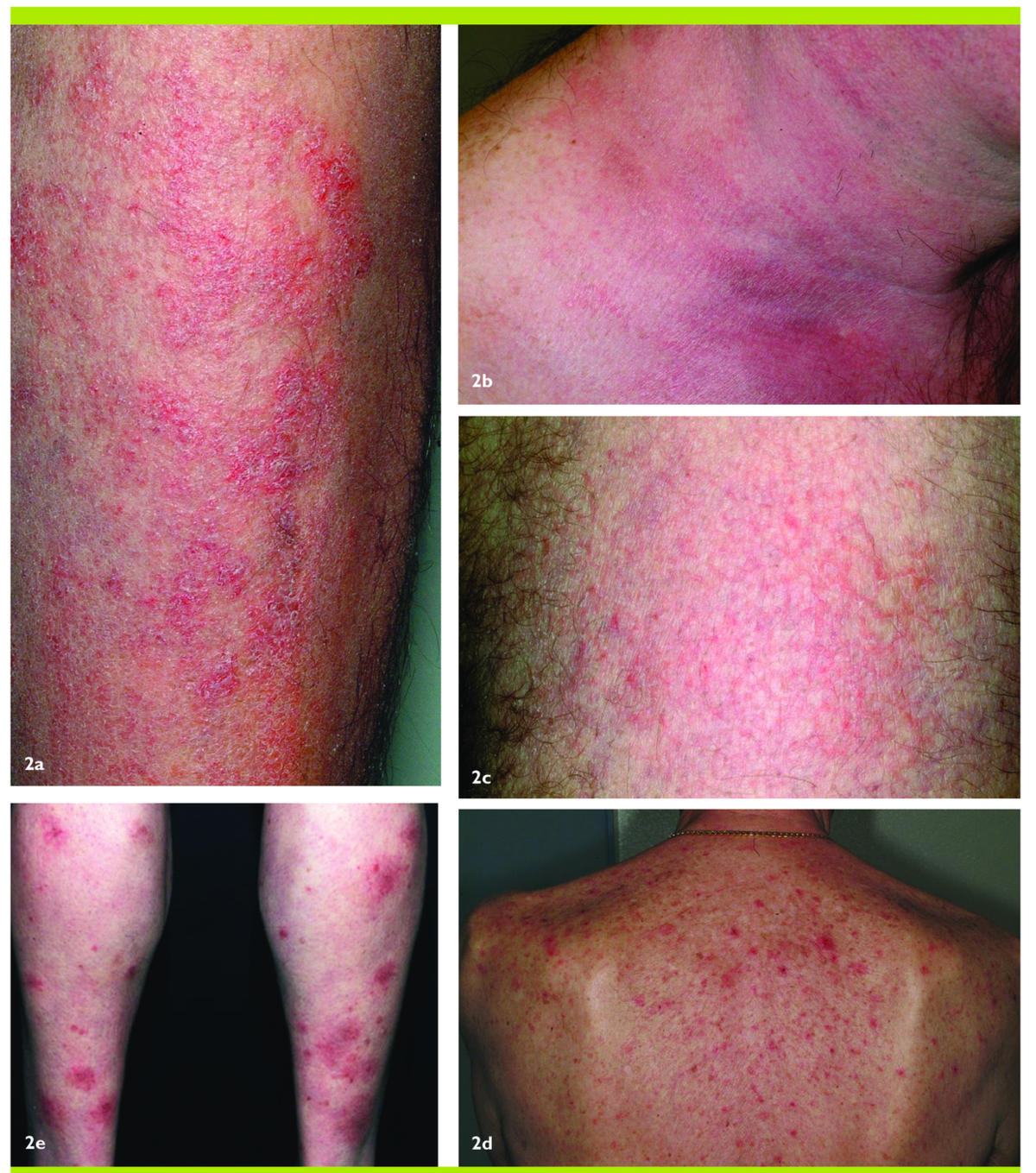 La dermatite associée au traitement de l'hépatite C chronique