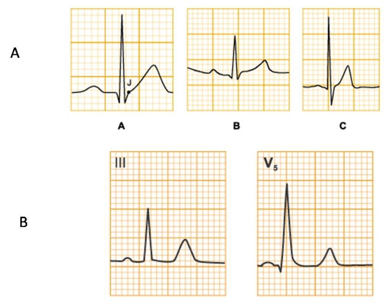 ECG anormal à 12 dérivations