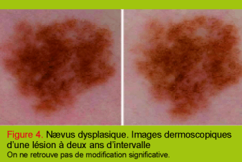 Surveillance des lésions mélanocytaires - Revue Médicale Suisse
