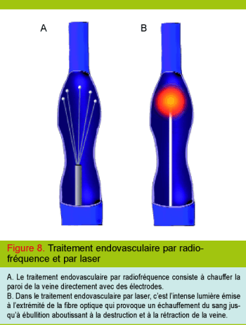 Traitement par laser ou radiofréquence contre les varices Traitement par laser ou radiofréquence contre les varices