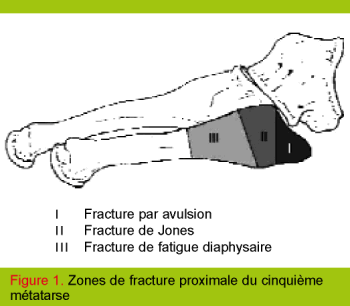 fracture 5ème métatarse guerison fracture 5ème métatarse guerison