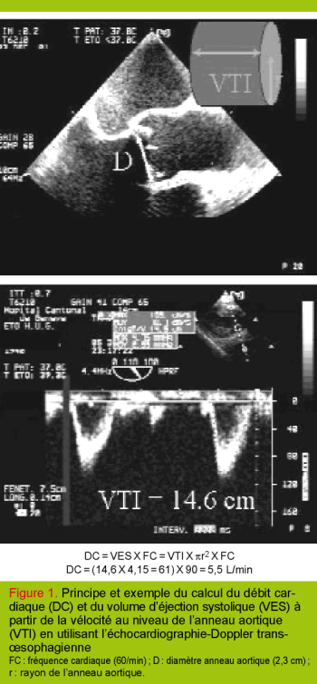 Techniques Non Invasives De Mesure Du Debit Cardiaque Revue Medicale Suisse