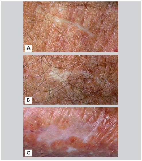 Dermatoporose un syndrome émergent Revue Médicale Suisse