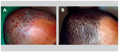 Les histoires des maladies selon le psoriasis