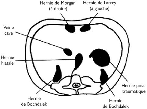 Hernie diaphragmatique congenitale