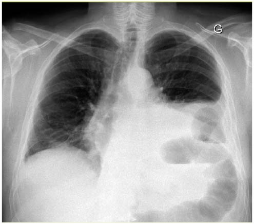 La Hernie De Bochdalek Cause Rare De Dyspnee Et De Douleurs Abdominales Chez L Adulte Revue Medicale Suisse