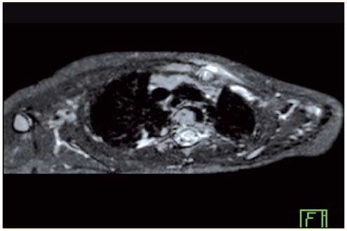 Infections Osteo Articulaires Septiques A Culture Negative Chez L Enfant Avez Vous Pense A Kingella Kingae Revue Medicale Suisse