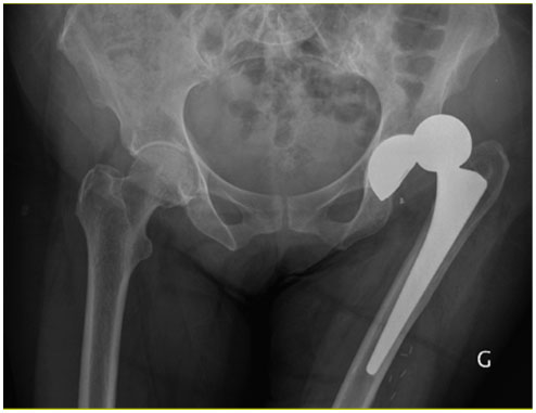 Résultat de recherche d'images pour "luxation de prothèse de hanche"