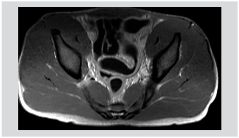 Evolution De L Imagerie Abdominale Chez L Enfant Developpement Des Applications En Irm Revue Medicale Suisse