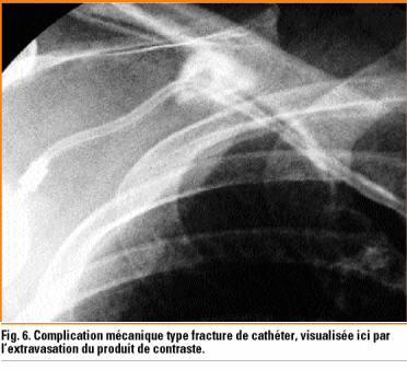 Dispositif D Acces Veineux Central Totalement Implantable Revue
