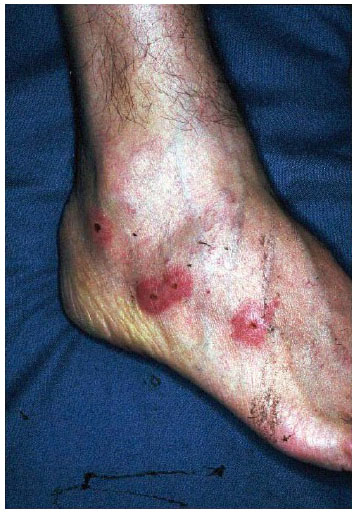 Dermatoses au retour de voyages : étiologies en fonction ...