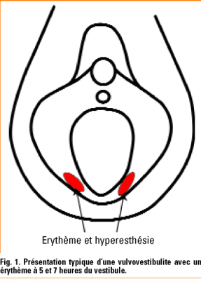 Vulvodynies Et Vulvovestibulites La Demarche Diagnostique Est Toujours Necessaire Revue Medicale Suisse