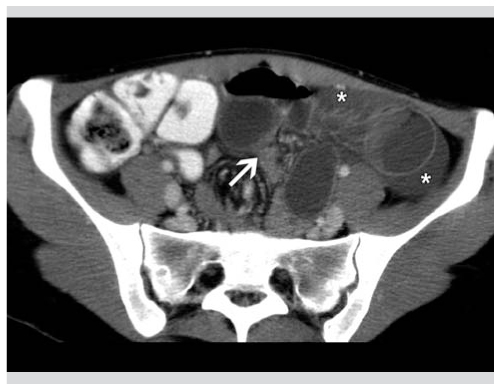 Occlusion Grele Aigue Traitement Conservateur Ou Chirurgical Revue Medicale Suisse