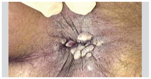 HPV-fertőzés tünetei és kezelése