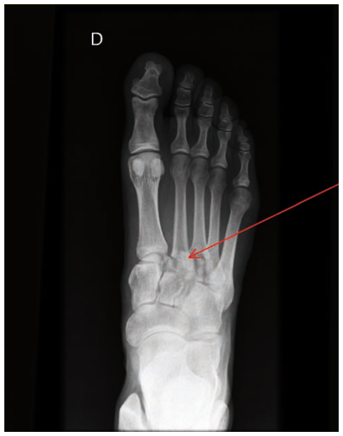 Pièges En Orthopédie Ambulatoire Le Membre Inférieur 2 - 