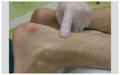Diagnostic Et Traitement De La Rupture Du Tendon D Achille Revue Medicale Suisse