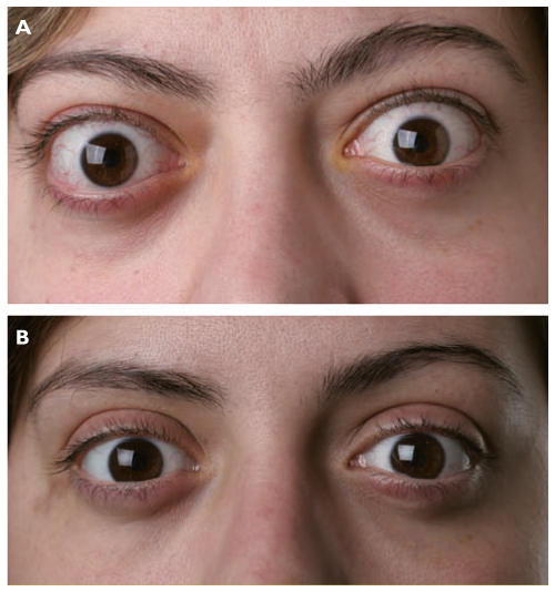 Ophtalmologie Revue Médicale Suisse