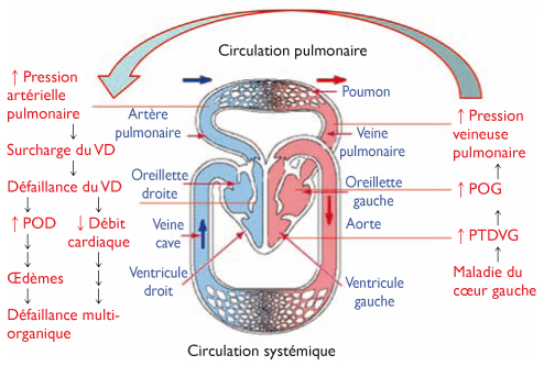 Hypertension Pulmonaire Associee Aux Maladies Du Cœur Gauche