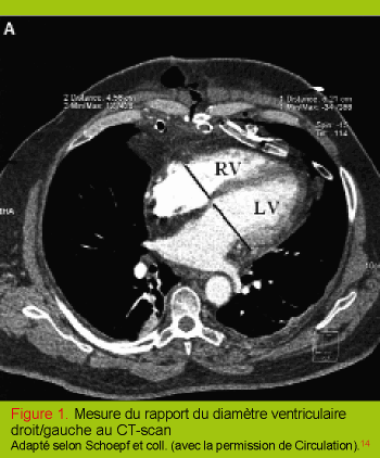 Etablir Le Pronostic De L Embolie Pulmonaire Est Ce Important