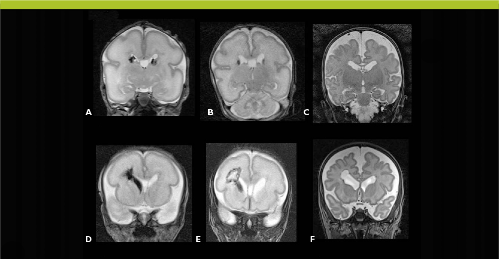 Lesions Cerebrales Du Premature Et Techniques D Imagerie A Visee
