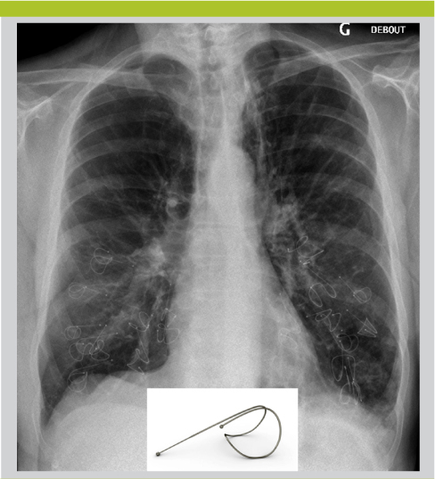 Réduction de volume pulmonaire dans l’emphysème sévère : importance d ...