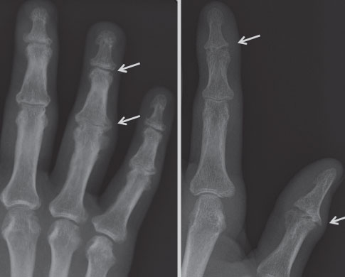 Rhumatologie: Rhumatisme psoriasique - Revue Médicale Suisse