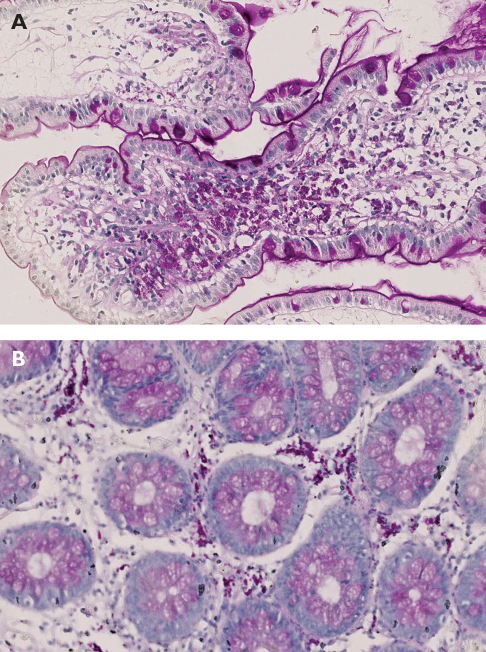 Maladie de Whipple quand y penser ? Revue Médicale Suisse