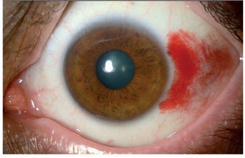 Hypertension Arterielle Et œil Revue Medicale Suisse