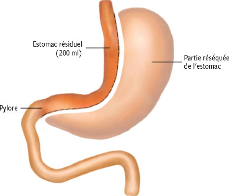 Chirurgie bariatrique  et risque accru de  d pendance  l 