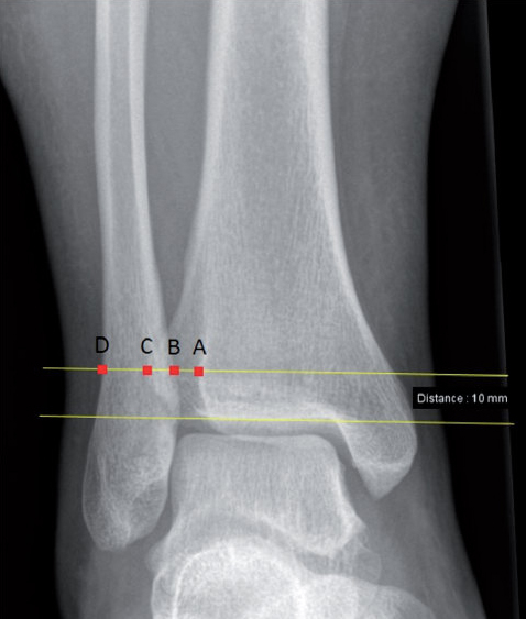 Lésions isolées de la syndesmose tibio-fibulaire distale - Revue ...