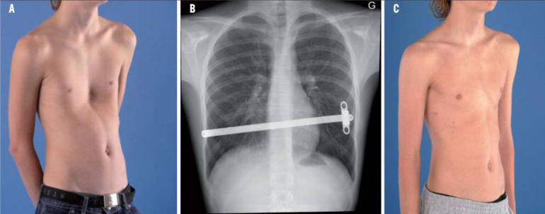 Pectus excavatum et carinatum chez l'enfant et l ...