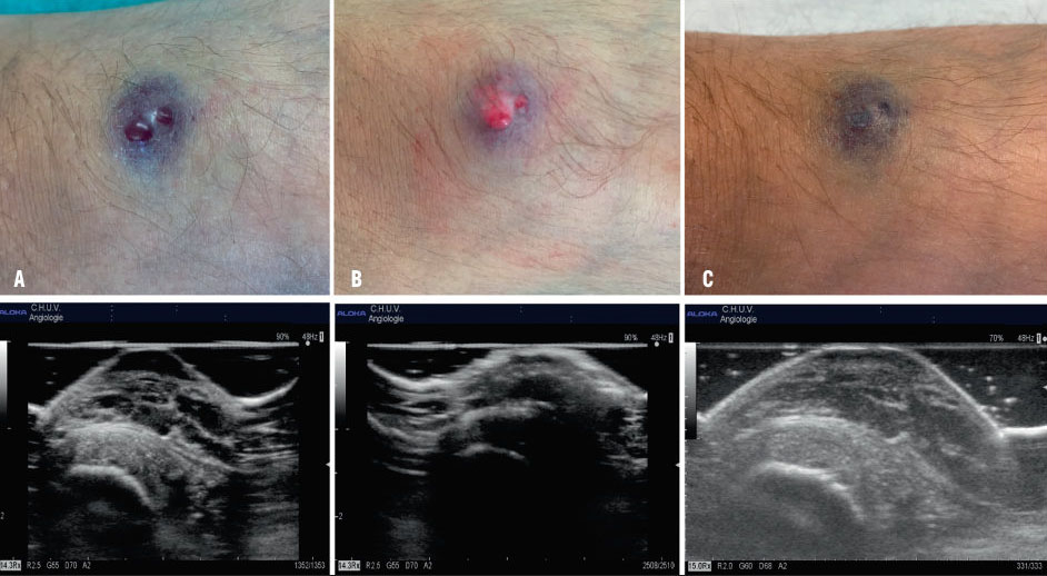 malco varicose vena tromboflecti)