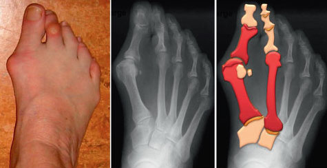 hallux valgus traitement sans chirurgie- hallux valgus traitement sans chirurgie