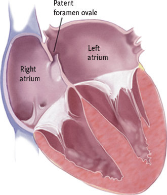 Fermeture du foramen ovale perméable où en sommesnous en 2018