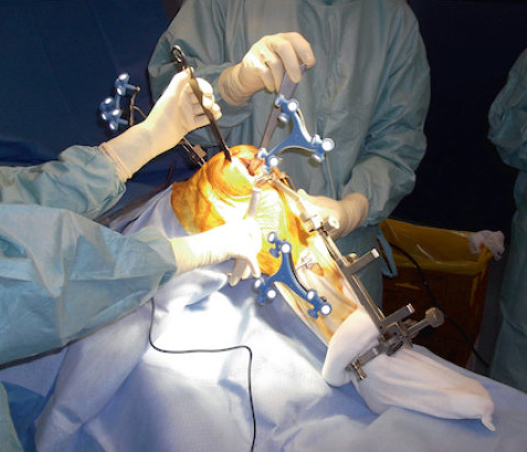 Chirurgie Robotique L Avenir De La Chirurgie Prothetique Revue Medicale Suisse